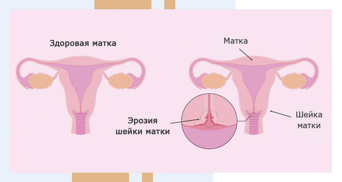Можно ли забеременеть при эрозии шейки матки?