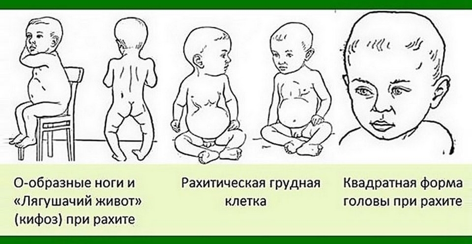 Признаки рахита у детей до года