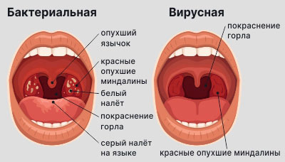 Профилактика ангины у детей. Как избежать ангины?